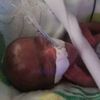 Beba rođena sa 245 grama napunila pet mjeseci iako su joj predvidjeli nekoliko sati života