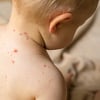 Broj oboljelih od morbila u Sarajevu opada, nema kraja epidemiji dok su djeca nevakcinisana