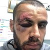 Slaven Belupo objavio fotografije nogometaša kojeg su brutalno pretukli željeznom šipkom