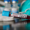 Kod još pet osoba u Srbiji potvrđen koronavirus, ukupno 24 zaraženih