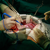 U BiH prvi put od početka pandemije transplantiran organ