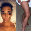Kim Kardashian o svojoj borbi sa kožnim oboljenjima: Ne smeta mi, prihvatila sam to