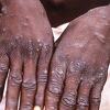 Rijedak virus iz Afrike: U Evropi, Americi i Australiji strahuju od epidemije majmunskih boginja
