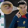 Ronaldov dolazak na trening otkrio povredu koju je zadobio na posljednjoj utakmici