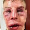 MMA borci izgledaju neprepoznatljivo nakon jedne od najbrutalnijih borbi ikada