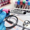 Težak novi oblik majmunskih boginja posebno pogađa ljude sa uznapredovalim HIV-om