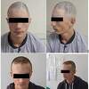 Zenički neurohirurzi mladiću iz Konjica ugradili dio lobanje izrađen na 3D printeru