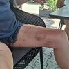 Neugodno iskustvo Bugojanke u Baškoj Vodi nakon što se srušilo stablo na plažu i povrijedilo je