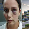 Ovako izgleda radnica hotela Jablanica koju je pretukao gazda, a njega pustili na slobodu?
