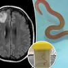 Nevjerovatan slučaj: Ljekari iz mozga Australke izvadili živog crva dugog osam centimetara