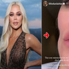 Khloe Kardashian pokazala lice nakon operacije melanoma, ostalo joj veliko udubljenje