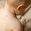 WHO: U više od polovine zemalja svijeta može izbiti epidemija morbila