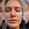 Bouchard doživjela neugodnu povredu oka tokom igranja pickleballa