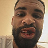 Loftus-Cheek podijelio stravičnu fotografiju nakon povrede vilice, izgubio je nekoliko zuba