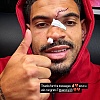 Gibbs-White pokazao unakaženo lice nakon stravičnog sudara, zaradio je šavove od čela do nosa