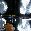 Kada započeti mamografiju? Različite preporuke otežavaju odluku ženama