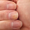 Kako prepoznati simptome psorijaze noktiju i na koji način ublažiti tegobe