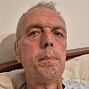 Hasib Kepeš ima maligni tumor pljuvačne žlijezde, za nastavak liječenja potrebno mu je 59.500 KM