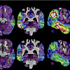 Eksperimentalni lijek pokazao prve ohrabrujuće rezultate u usporavanju Alzheimera
